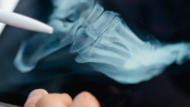 Бесплатное обследование для больных костно-суставными инфекциями (остеомиелитом) в клинике «Лозенец» УМБАЛ