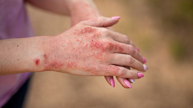 Какая связь между стрессом и экземой?