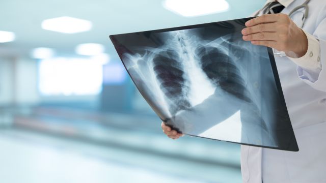 Асбестоз – профессиональное заболевание легких