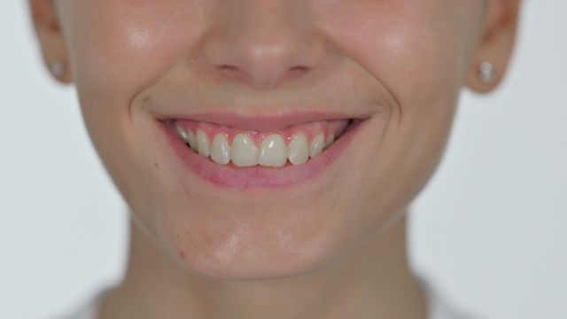 Роль десен в эстетике улыбки