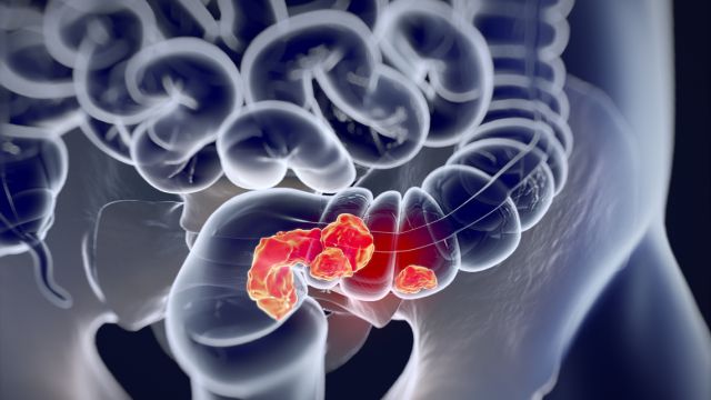 Хирургическое лечение рака прямой кишки