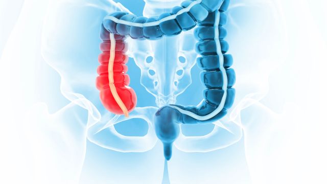 Коллагеновый колит – когда понос не имеет видимой причины при эндоскопии?