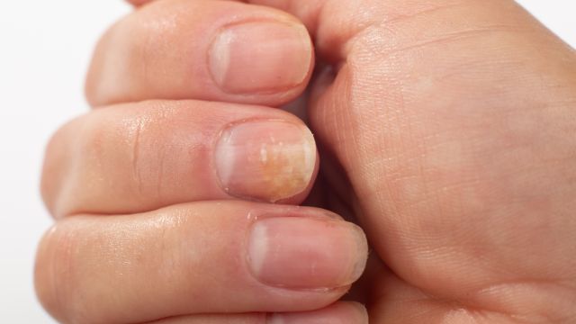 Микоз ногтей и распространенные ошибки в домашних условиях