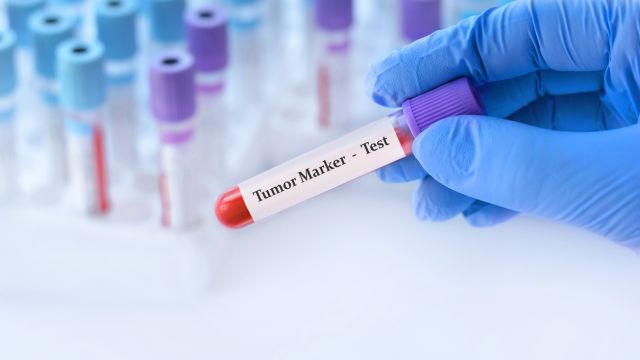 Роль онкомаркеров в диагностике рака