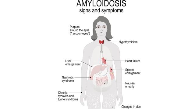 Системные проявления амилоидоза