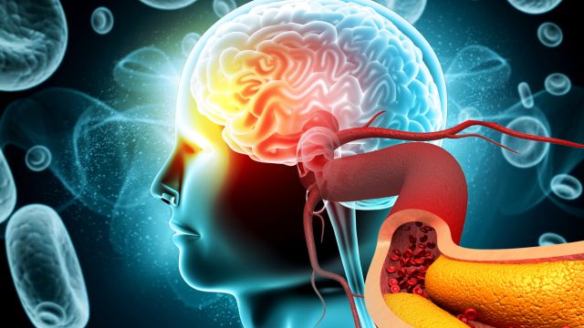 Что вызывает жировую эмболию легких и головного мозга после перелома кости?