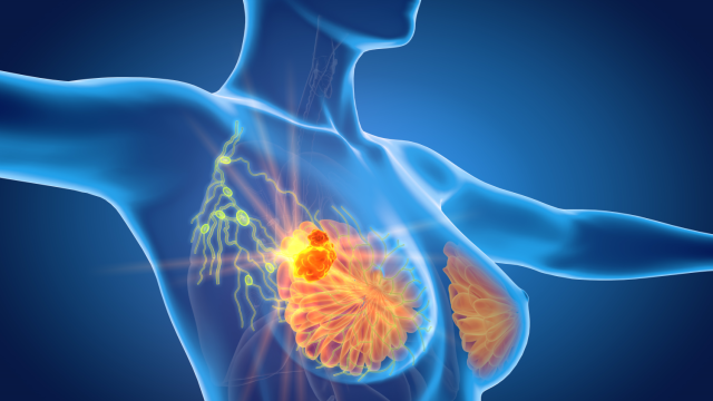 Случаи рака молочной железы у женщин до 30 лет выросли почти вдвое: УМБАЛ «Св.Марина» объявляет бесплатные обследования