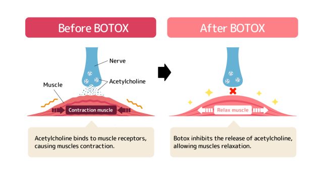 Каковы возможные варианты использования ботокса?