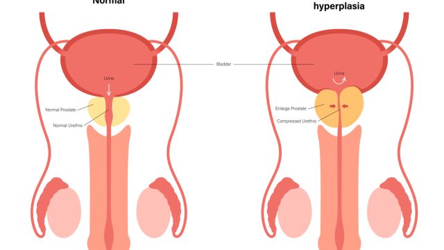 Почему с возрастом простата увеличивается?